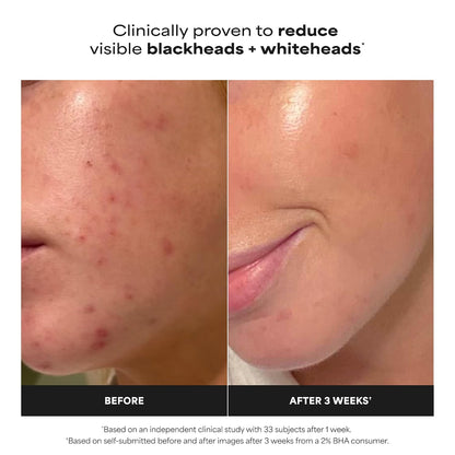 Paula's Choice Skin Perfecting 2% BHA Liquid Exfoliant - 30ml
