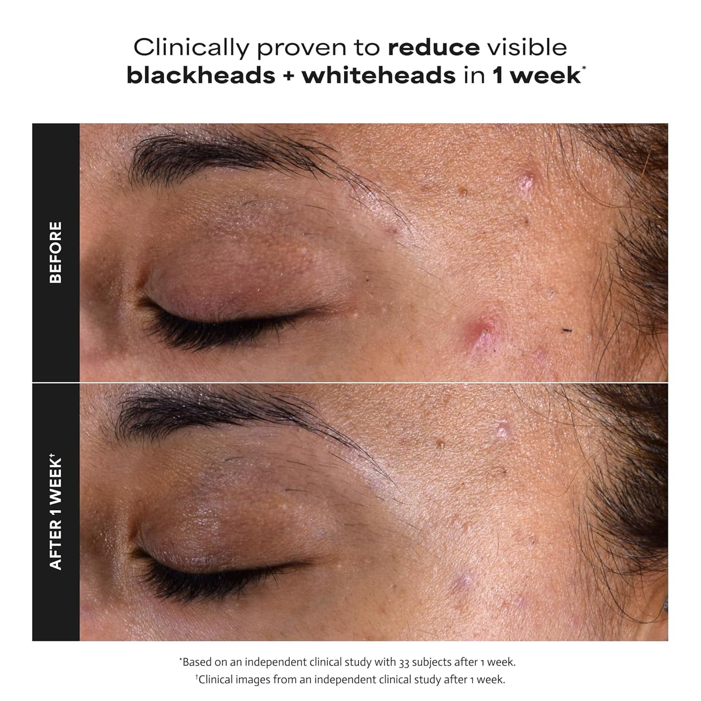 Paula's Choice Skin Perfecting 2% BHA Liquid Exfoliant - 30ml