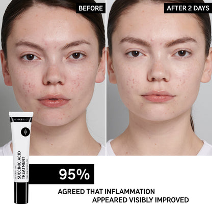 The Inkey List Succinic Acid Blemish Treatment 15ml